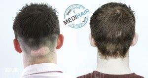 Haartransplantatie En Alternatieve Behandelingen