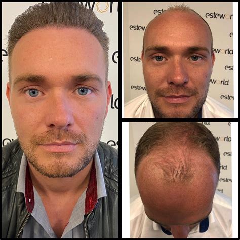 Haartransplantatie Mythen Ontkracht