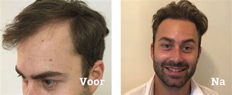 Ervaringen Van Patiënten Met Haartransplantatie