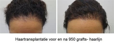 Haartransplantatie Voor Vrouwen: Wat Zijn De Opties?