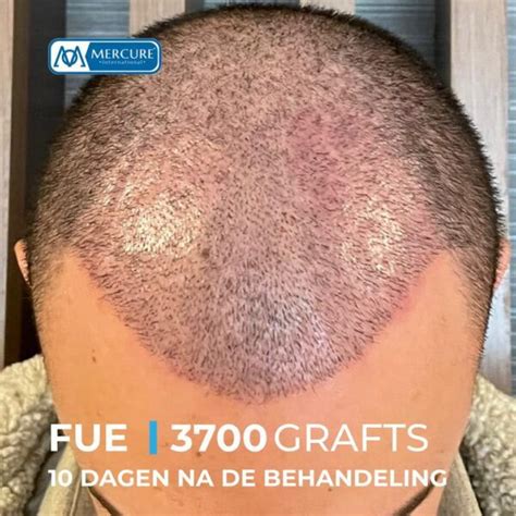 Saffier FUE Haartransplantatie: Waarom Kiezen?