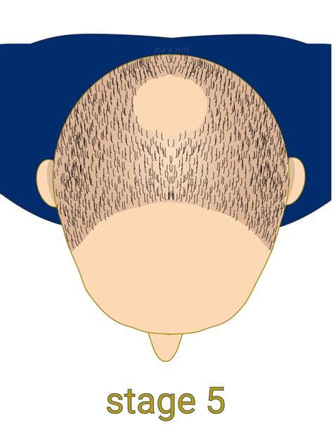 De Top 5 Mythen Over Haartransplantatie
