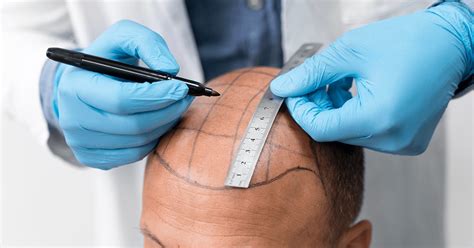 Haartransplantatie In 2023: Wat Zijn De Innovaties?