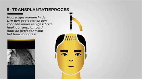 Haartransplantatie Met DHI Technologie: Is Het De Tijd Waard?