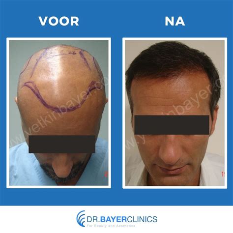 Haartransplantatie Voor En Na: Klantverhalen